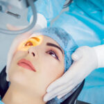 Recommendations from experts for cataract surgery