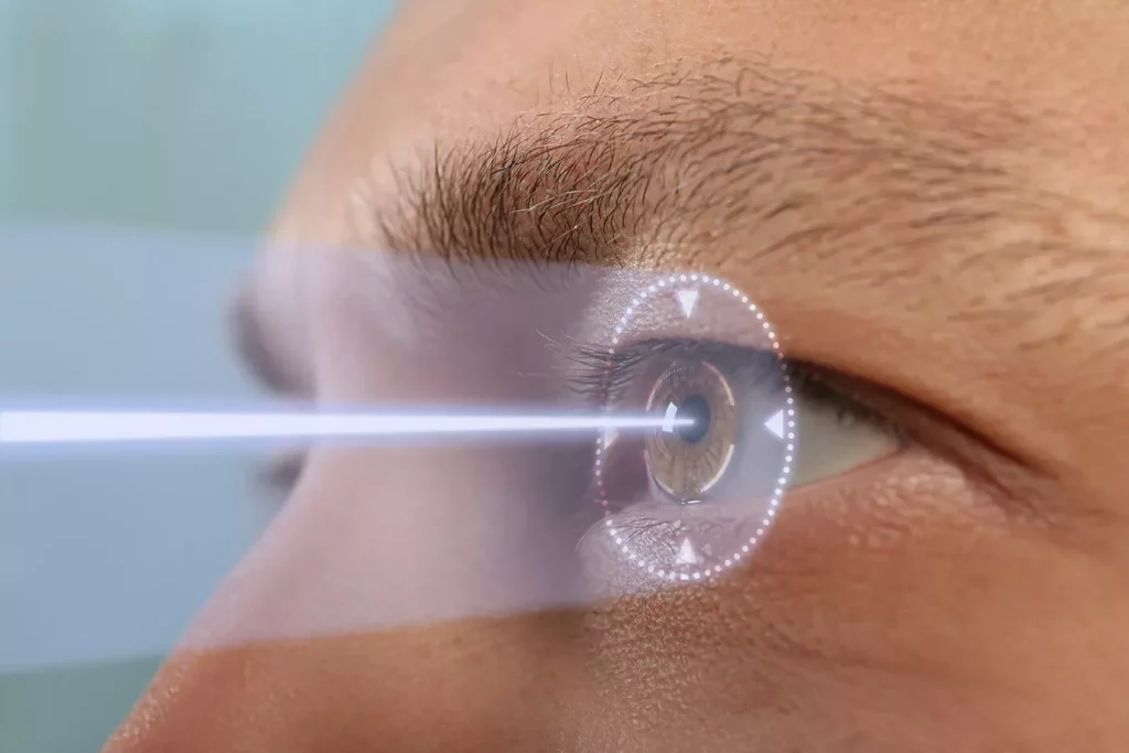 LASIK laser eye surgery